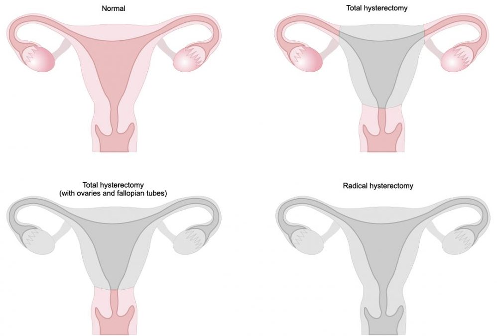 Hysterectomy and Menopuase Part 2